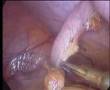 Appendix Operation by Dr.Kuldeep
