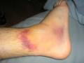 videos de Shaun Lavallee Ankle Injury