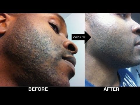 how to treat razor bumps