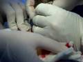 Ankle-surgery