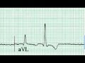 ECG Interpretation, First Impressions, Part 6-1