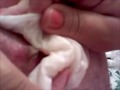 my mom popped a cyst on my back part 1