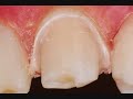 Preparacion Dentaria