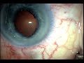 catarata-ifis-sindrome-iris-flacido-intraoperatorio.html