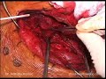 Scapulothoracic Fusion for Fascoscapulohumeral Muscular Dystrophy, Part 4 Scapulothoracic Fusion for Fascoscapulohumeral Muscular Dystrophy, Part 4
