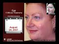 Spectra VRM Laser Treatment : 532nm Peel Testimonial