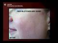 Spectra VRM Laser Treatment : 532nm Peel Testimonial