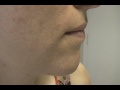 The Acne Practice  (Live Documentary #4  -- part 4)