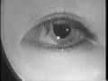 positional nystagmus 4
