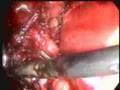 Difficult Laparoscopic Cholecystectomy