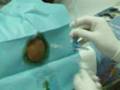 Pericardiocentesis Pericardiocentesis