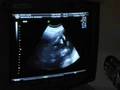 Ecografia 22 semanas - 22 weeks ecography