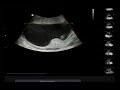 20 Week Sonogram (3 of 3)