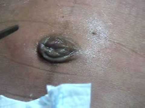 how to treat omphalitis