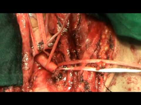 how to measure cardiomegaly on cxr
