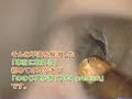 ????Ear cleaning