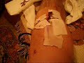 the horrors of knee surgery