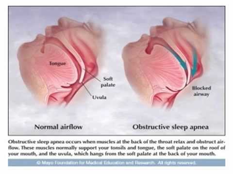 how to cure obstructive sleep apnea