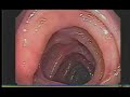 DIVERTICULOS del colon TV12 Dr. Julio Murra Saca 2 parte