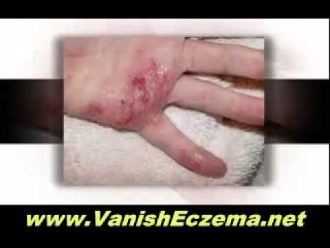 how to bleach bath for eczema