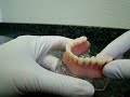 As dentaduras limitam a vida de quem as usa. Os implantes dentários podem ser a solução para mastigar e sorrir com tranquilidade.