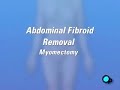 PreOp® Patient Myomectomy Abdominal Fibroid Removal Surgery