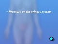PreOp® Patient Myomectomy Abdominal Fibroid Removal Surgery Infections and Pregnancy