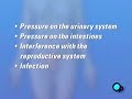 PreOp® Patient Myomectomy Abdominal Fibroid Removal Surgery