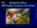Minimally-Invasive Joint Replacement Part 3 Minimally-Invasive Joint Replacement Part 3