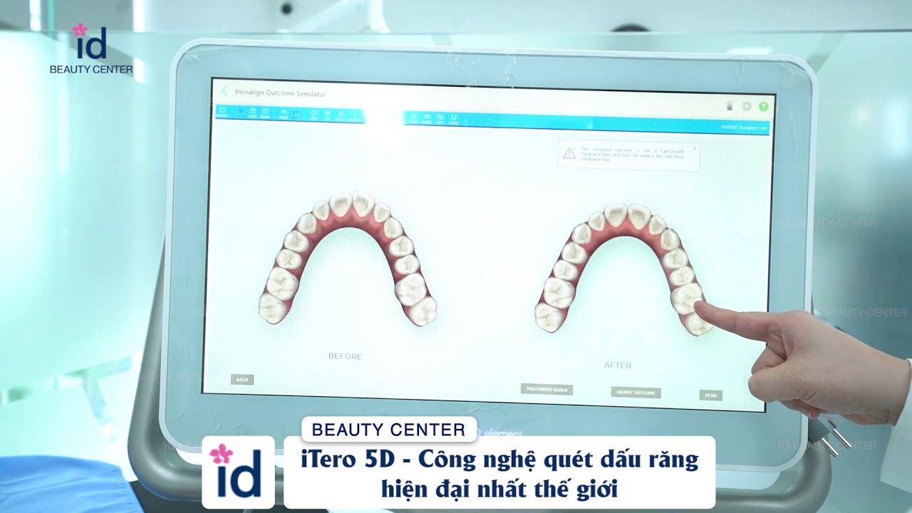 iTero 5D | Công nghệ quét dấu răng hiện đại nhất thế giới tại id Beauty Center