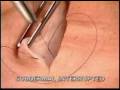 videos de subdermal interrupted suturing jomar marcelo good closure skin surgery medicine surgical suturing of skin hospital medical center residency registrar officer wound closure