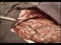 Decoding Epilepsy, Part II: Mapping the Brain\ Decoding Epilepsy, Part II: Mapping the Brain\