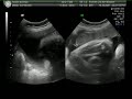 Little Takka Fowler - 39 Weeks