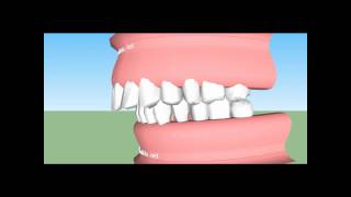 Classificação de Angle {Classe 1, Classe 2, Classe3}