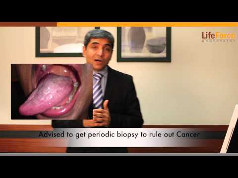 how to cure lichen planus