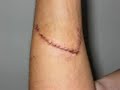 READ!: This is me sharing my story of self-injury. This is dedicated to all of the people who have struggles with self-injury. I'm here to talk anytime if you need to. I'll understand you. Also, the picture at 1:56 wasn't meant to be there. I put it in there before I decided to do my own story rather tham a story of self-injury overall. So pay no attention to it, I forgot to take it out. Also, the scar at 1:32.. if you're wondering why that looks so infected is because i tried to get my friend to do it for me so I didn't have to tell my parents. :( Never do that!Also, a few of these are pictures from my friend. She wanted to make a video too, but was too nervous. So she asked if I could put them in mine. I only put this in my description because so many people are like.. some of these look different from the others!! blahblahblah.Song:Truly, Madly, Deeply by Patty Carlson. DON'T LEAVE COMMENTS IF YOU'RE GOING TO BE STUPID AND ARROGANT. WE DON'T NEED THEM HERE. I'M NOT DOING THIS FOR ATTENTION, I'M DOING IT TO HELP PEOPLE. SO FOR CHRIST SAKES, STOP LEAVING ARROGANT COMMENTS. -------------------------Update 24th June, 2006:#59 - Most Discussed (All Time) - Education - United KingdomUpdate 13th June, 2008:#77 - Most Discussed (All Time) - EducationAlso, I'm going to stop posting updates on the number of view, they're going up like mad! It makes me so happy to know how many people I can possibly help. Update 1st June, 2008:13,000 views! I never realised that my video would be so popular. I'm so happy that I can help so many people! :)Update 26th May, 2008:12,000 views!#80 - Most Discussed (All Time) - Education - United KingdomUpdate 22nd May, 2008:#85 - Most Discussed (All Time) - Education - United KingdomUpdate 20th May, 2008:Wow! 11,000 views! :) I'm so happy I'm getting my story out there to people.Update 15th May, 2008:#86 - Most Discussed (All Time) - Education