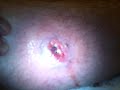 Abscess pus coming out my poisonous infected leg 3