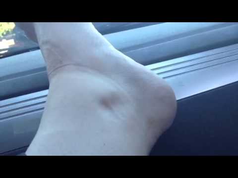 how to measure pitting edema