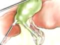 Malpractice Medical Gallbladder Removal Hassan Surgery 3