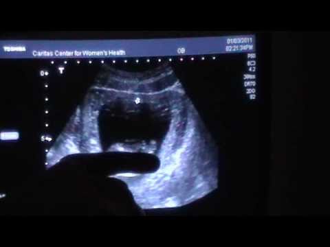 how to locate placenta on ultrasound
