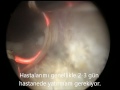 Kapalı Prostat Ameliyatı Plazmakinetik Yöntem..