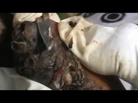 how to treat jigger infestation