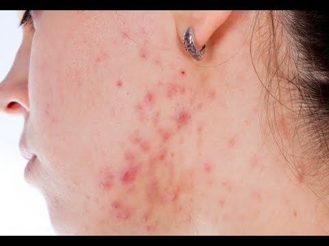 how to cure acne due to hormonal imbalance