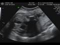 videos de Ultrasound Stroud Baby March 2009