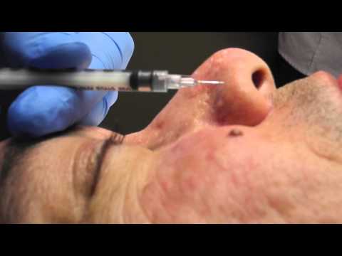 how to perform tca cross