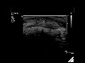 chalazion