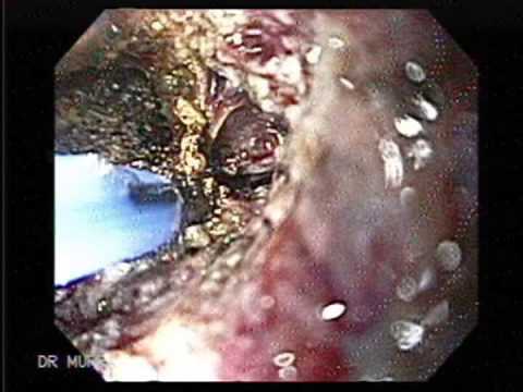 how to relieve gas after egd