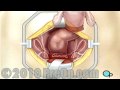 PreOp® Patient Education Hysterectomy Removal of Uterus, Ovaries and Fallopian Tubes Surgery