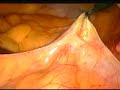 Laparoscopic-Assisted Percutaneous Vaginal Tape Vault Suspension (Dramatic Health)
