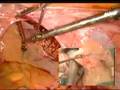 Vaginal Tape Vault Surgery Vaginal Tape Vault Surgery